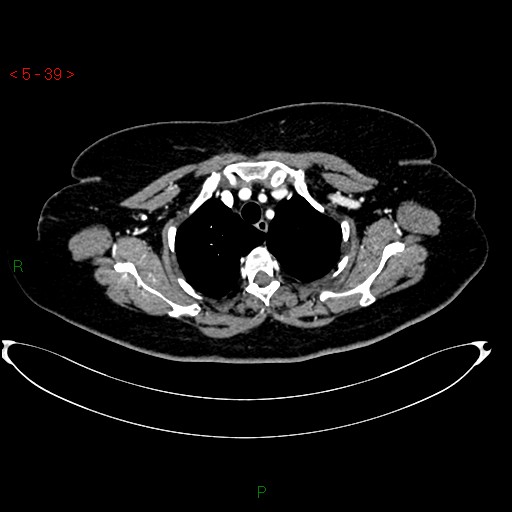File:Azygos fissure and lobe (Radiopaedia 47620-52278 A 25).jpg