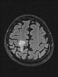 File:Balo concentric sclerosis (Radiopaedia 50458-55940 Axial FLAIR 9).jpg