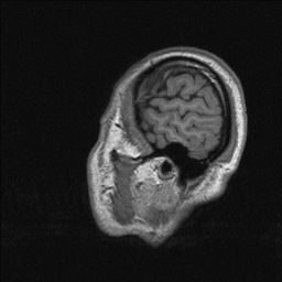 Balo concentric sclerosis (Radiopaedia 50458-55940 Sagittal T1 138).jpg