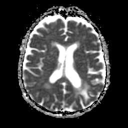 File:Balo concentric sclerosis (Radiopaedia 53875-59982 Axial ADC 15).jpg