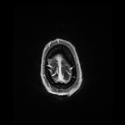 Balo concentric sclerosis (Radiopaedia 53875-59982 Axial LAVA C+ 248).jpg