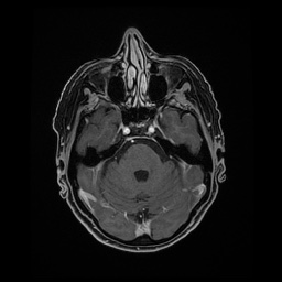 Balo concentric sclerosis (Radiopaedia 53875-59982 Axial LAVA C+ 80).jpg