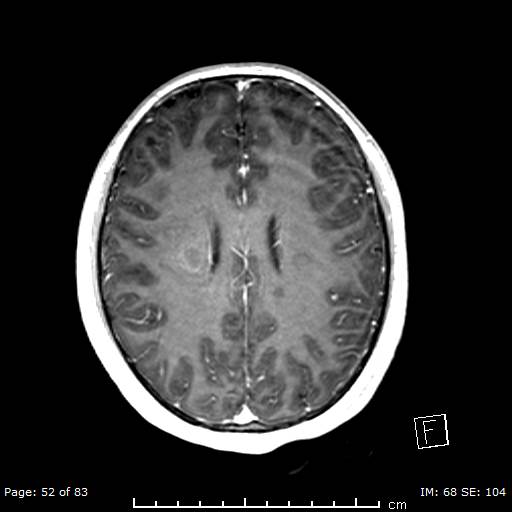 Balo concentric sclerosis (Radiopaedia 61637-69636 Axial T1 C+ 52).jpg