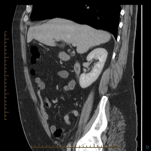 File:Bariatric balloon causing gastric outlet obstruction (Radiopaedia 54449-60672 C 55).jpg