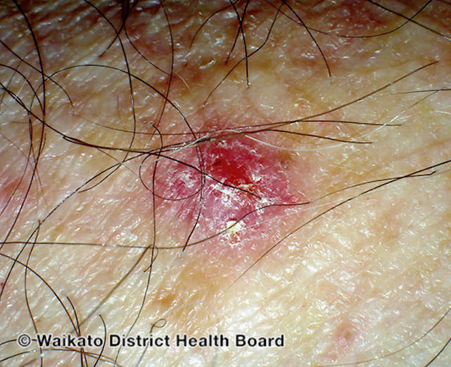 File:Basal cell carcinoma affecting the arms and legs 11 macro (DermNet NZ bcc-11-macro).jpg