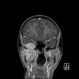 Base of skull rhabdomyosarcoma (Radiopaedia 32196-33142 I 28).jpg