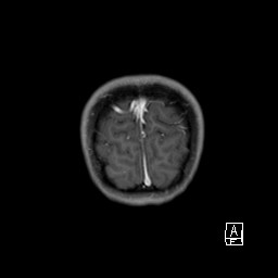 File:Base of skull rhabdomyosarcoma (Radiopaedia 32196-33142 I 68).jpg