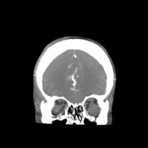 Basilar and bilateral vertebral artery occlusion (Radiopaedia 45592-49723 B 26).png