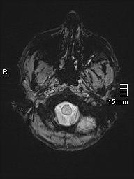 File:Basilar artery perforator aneurysm (Radiopaedia 82455-99523 Axial SWI 4).jpg