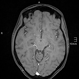 Basilar artery perforator aneurysm (Radiopaedia 82455-99523 F 64).jpg
