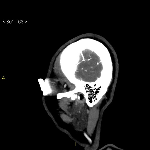 File:Basilar artery thrombosis (Radiopaedia 16260-15944 C 62).jpg