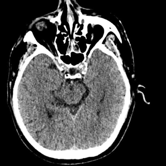 Basilar artery thrombosis (Radiopaedia 53351-59333 Axial non-contrast 55).jpg