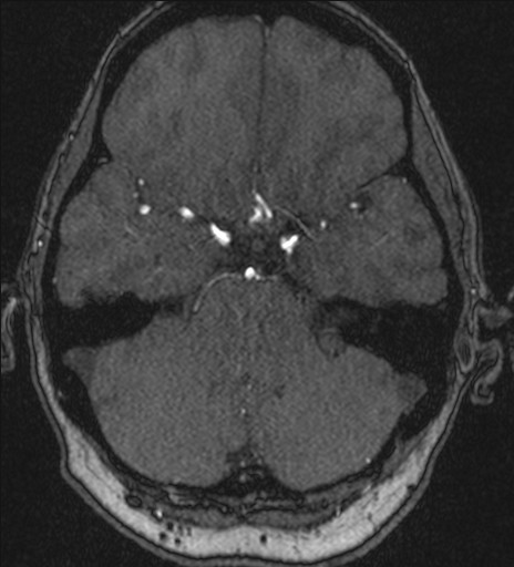 Basilar tip aneurysm (Radiopaedia 26504-26632 MRA 66).jpg