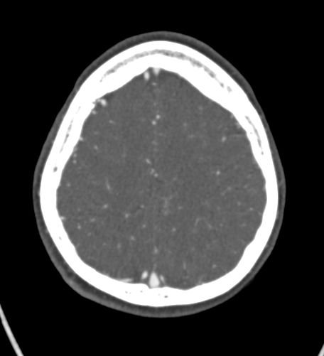 Basilar tip aneurysm with coiling (Radiopaedia 53912-60086 A 119).jpg