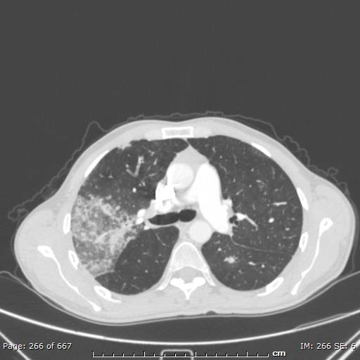 File:Behçet disease (Radiopaedia 44247-47889 Axial lung window 33).jpg