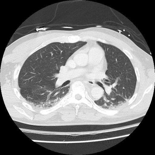 Benign post-traumatic pseudopneumoperitoneum (Radiopaedia 71199-81495 Axial lung window 37).jpg