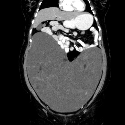 File:Benign spindle cell tumor - abdominopelvic (Radiopaedia 61300-69212 C 21).jpg