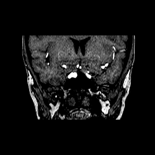 File:Berry aneurysm of the terminal internal carotid artery (Radiopaedia 88286-104918 Coronal TOF 31).jpg
