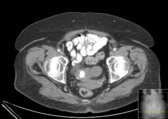 Bicameral celiacomesenteric aneurysm (Radiopaedia 55766-62327 A 66).jpg