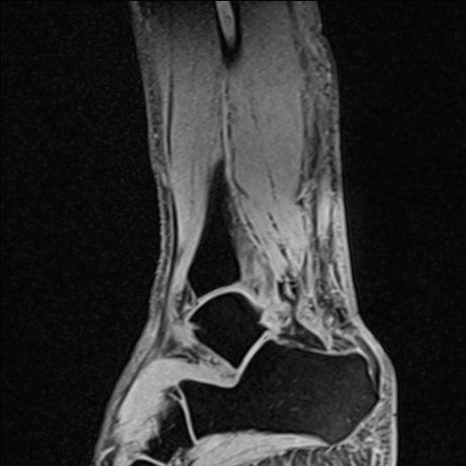 Bilateral Achilles tendon complete tear (Radiopaedia 81344-95051 Sagittal WE - Right 38).jpg
