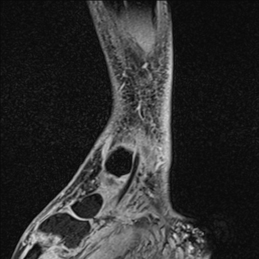 Bilateral Achilles tendon complete tear (Radiopaedia 81344-95051 Sagittal WE - Right 86).jpg
