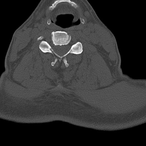 File:Bilateral C6-7 locked facet dislocation (Radiopaedia 28506-28748 Axial bone window 11).jpeg
