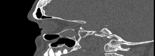 Bilateral Ectopic Infraorbital Nerves (Radiopaedia 49006-54084 Sagittal bone window 17).jpg