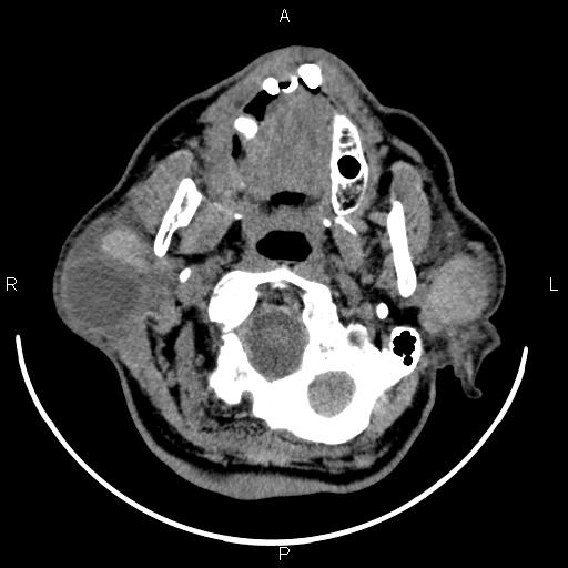 Bilateral Warthin tumors (Radiopaedia 84034-99263 Axial non-contrast 15).jpg