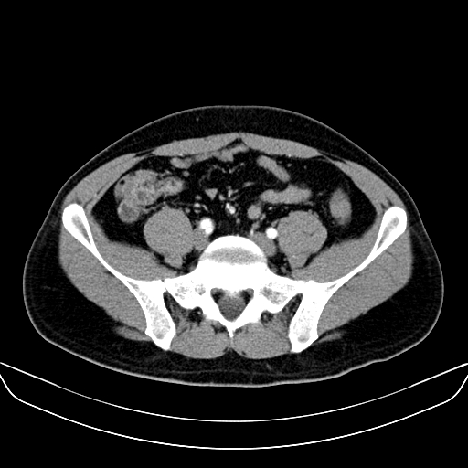 Bilateral accessory renal arteries with mild pelvi-ureteric junction (PUJ) obstruction (Radiopaedia 66357-75596 A 49).jpg