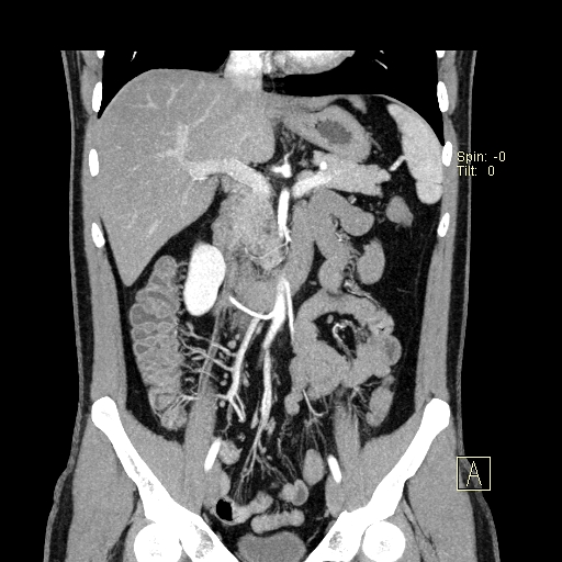File:Bilateral accessory renal arteries with mild pelvi-ureteric junction (PUJ) obstruction (Radiopaedia 66357-75596 B 12).jpg