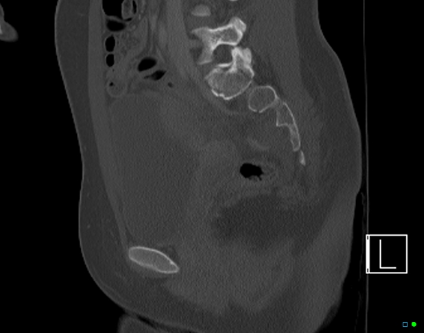 Bilateral acetabular fractures (Radiopaedia 79272-92308 Sagittal bone window 40).jpg