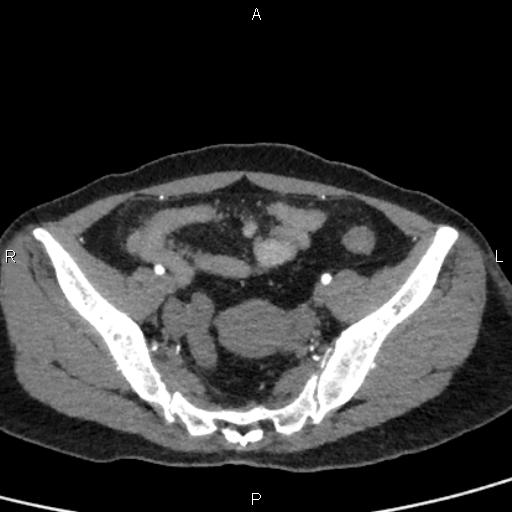 Bilateral adrenal gland hyperenhancement in pancreatitis (Radiopaedia 86642-102753 B 106).jpg