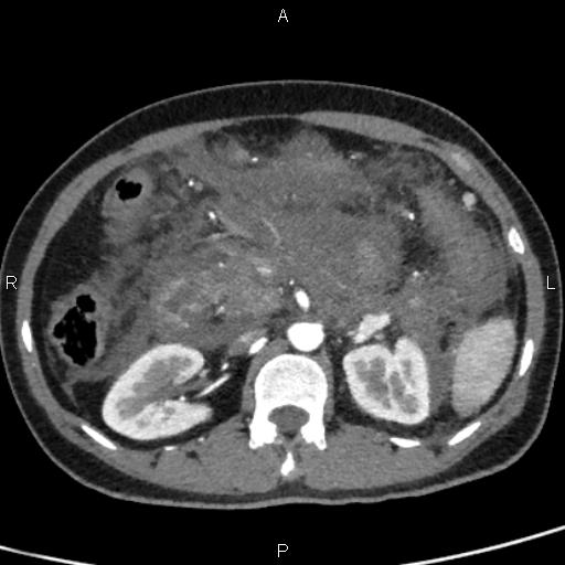 Bilateral adrenal gland hyperenhancement in pancreatitis (Radiopaedia 86642-102753 B 55).jpg