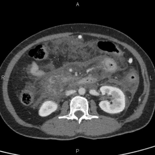 Bilateral adrenal gland hyperenhancement in pancreatitis (Radiopaedia 86642-102753 E 54).jpg