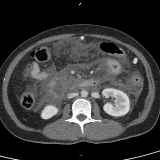 Bilateral adrenal gland hyperenhancement in pancreatitis (Radiopaedia 86642-102753 E 55).jpg