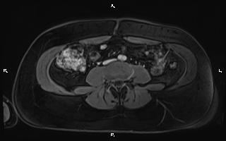 Bilateral adrenal myelolipoma (Radiopaedia 63058-71537 G 71).jpg