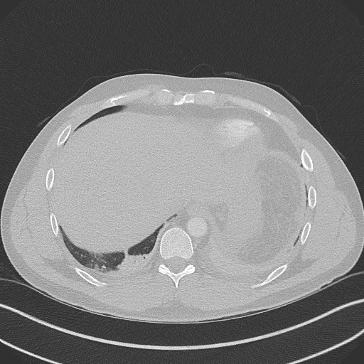 File:Bilateral atelectasis (Radiopaedia 48666-53675 Axial lung window 94).jpg
