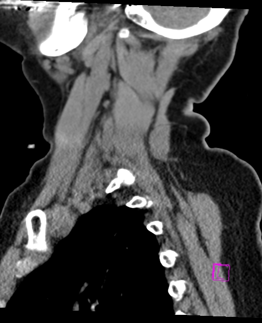 Bilateral atlanto-occipital assimilation (Radiopaedia 28350-28603 D 64).jpg