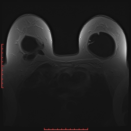 File:Bilateral breast implant rupture (Radiopaedia 24761-25027 PASTA 9).jpg