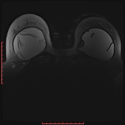 File:Bilateral breast implant rupture (Radiopaedia 24761-25027 PASTA Si 17).jpg