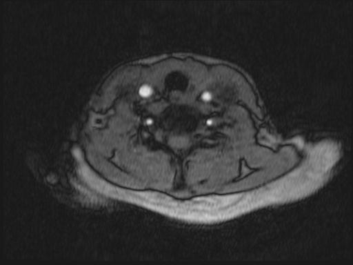 Bilateral carotid body tumors and right glomus jugulare tumor (Radiopaedia 20024-20060 Axial MRA 212).jpg