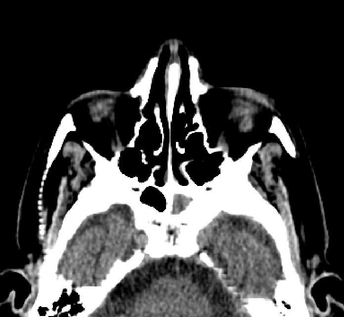 Bilateral ectopia lentis (Radiopaedia 89889-107013 Axial non-contrast 65).jpg