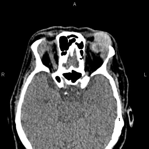 Bilateral enlargement of lacrimal glands - sarcoidosis (Radiopaedia 62627-70921 Axial non-contrast 55).jpg