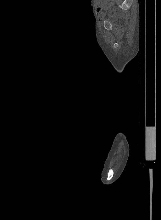 Bilateral fibular hemimelia type II (Radiopaedia 69581-79491 Sagittal bone window 56).jpg