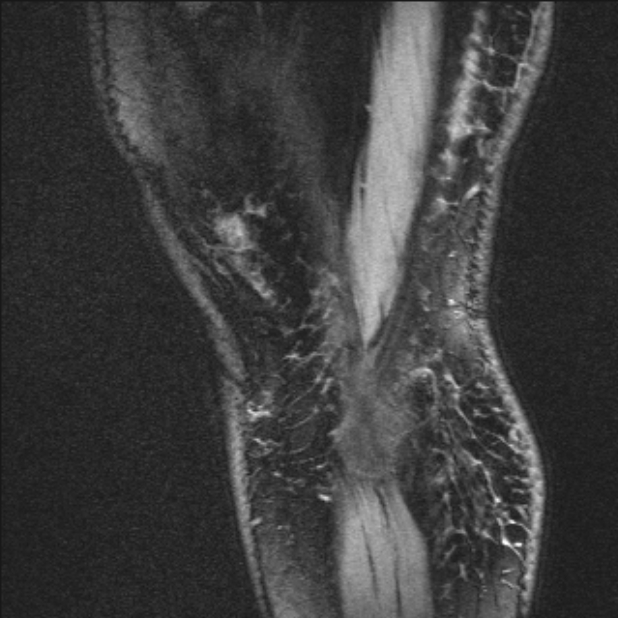 Bilateral focal pigmented villonodular synovitis (Radiopaedia 67643-77073 Sagittal T1 vibe 4).jpg