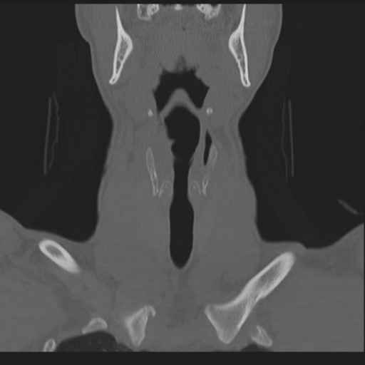 Bilateral locked facets (Radiopaedia 33850-35016 Coronal bone window 23).png