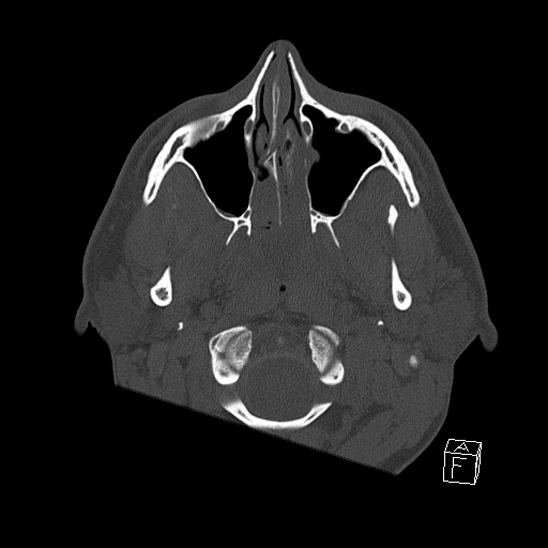 Bilateral occipital condyle fracture (type 2) (Radiopaedia 87675-104089 Axial bone window 4).jpg