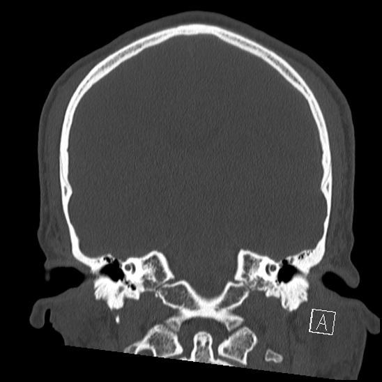 Bilateral occipital condyle fracture (type 2) (Radiopaedia 87675-104089 Coronal bone window 73).jpg