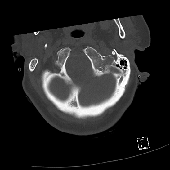 Bilateral occipital condyle fractures (type 3) (Radiopaedia 87672-104086 Axial bone window 10).jpg