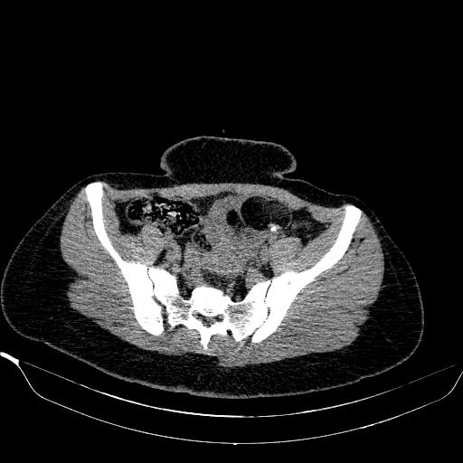 File:Bilateral ovarian dermoid (Radiopaedia 45714-49907 Axial non-contrast 16).JPEG